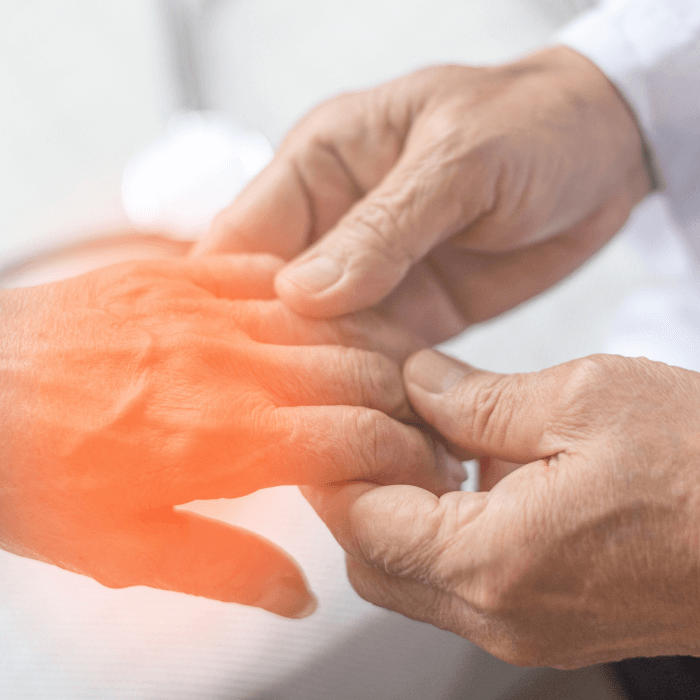 Artrosis de manos y dedos, causas, síntomas y tratamiento 