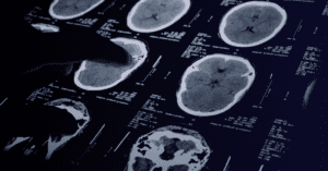¿Quién trata la neuralgia?