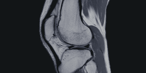 cuando volver a correr despues de lesion ligamentos